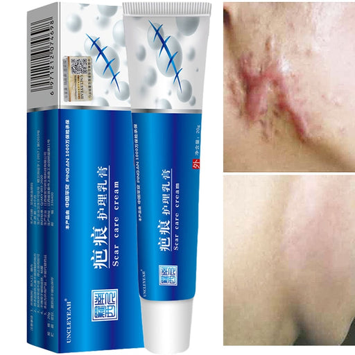 Acne Scar Removal